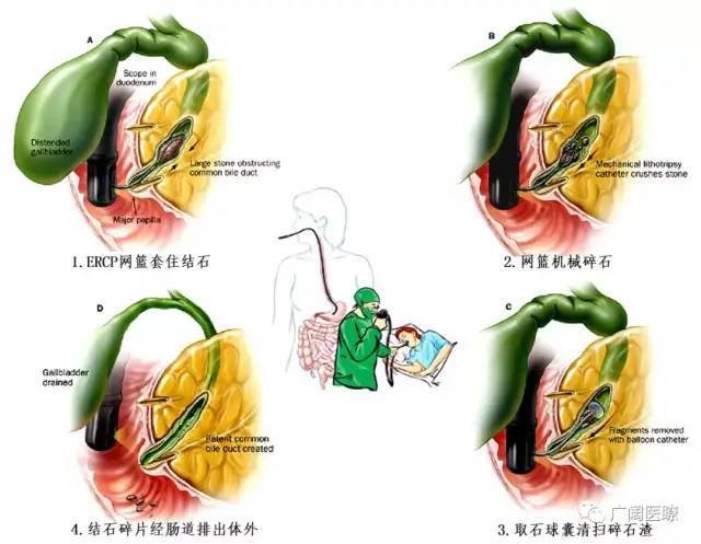 创新胆结石治疗技术解析